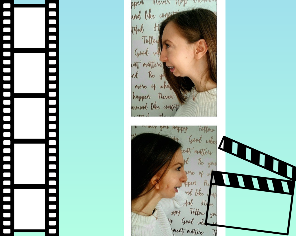 Image shows the side profile of Becky, highlighting underdeveloped jaw, ear and scars.